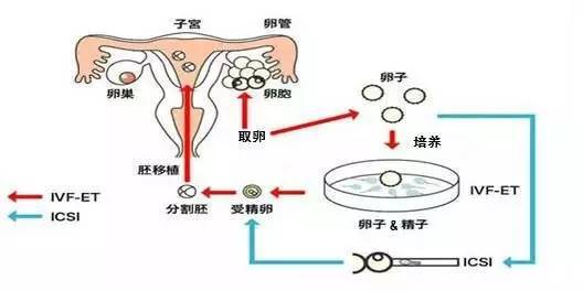 供卵试管婴儿